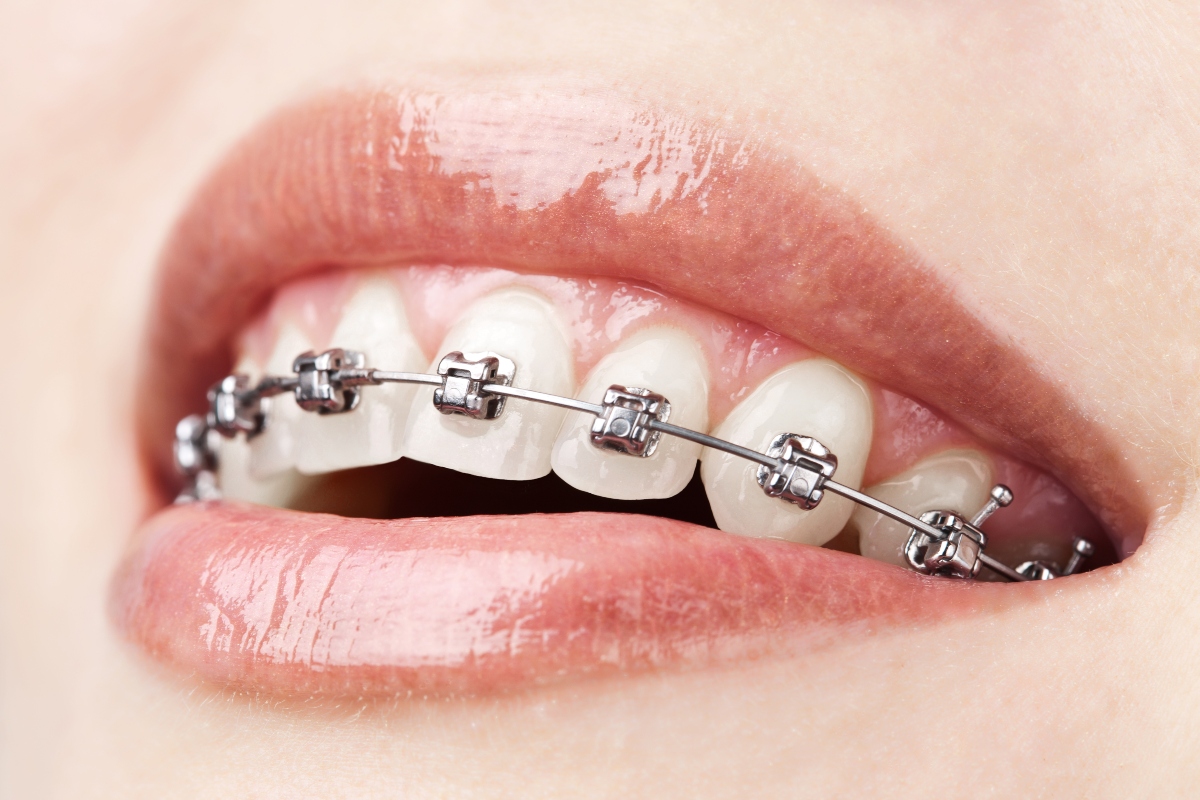 woman with braces